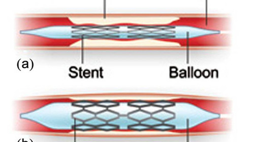 Coating Techniques and Release Kinetics of Drug-Eluting Stents