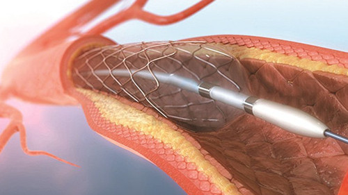 Heart Stent - Ultrasonic Stent Coating - Cheersonic